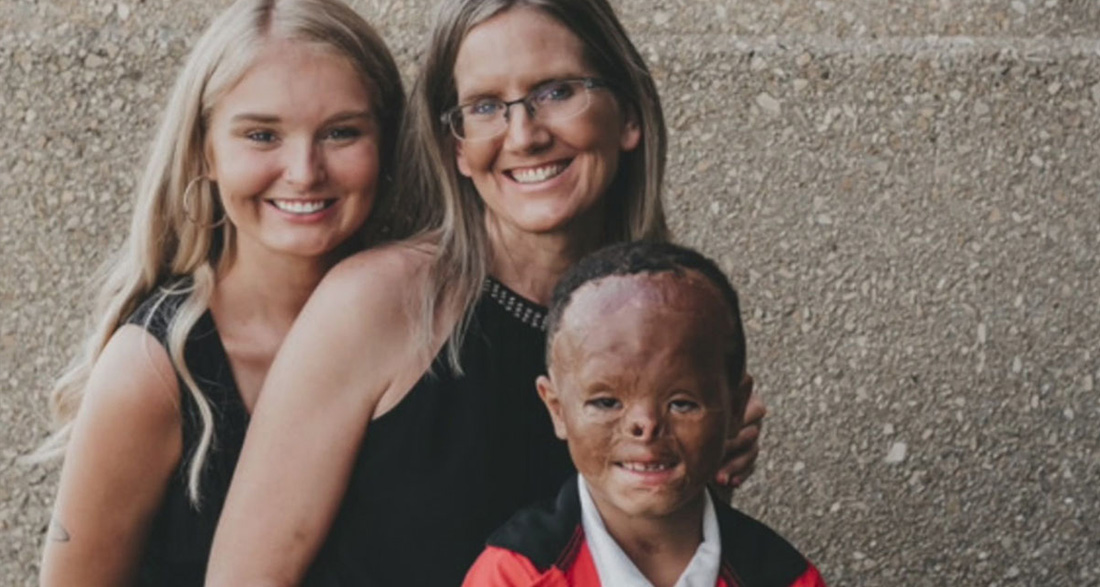 Foster baby is adopted 7 years after apartment fire left him with horrific burns