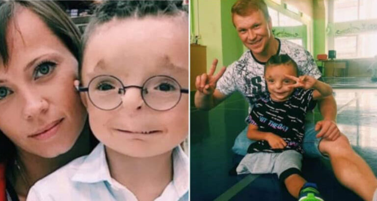 A kind-hearted woman adopted a child that nobody wanted to adopt – take a look at how he looks now
