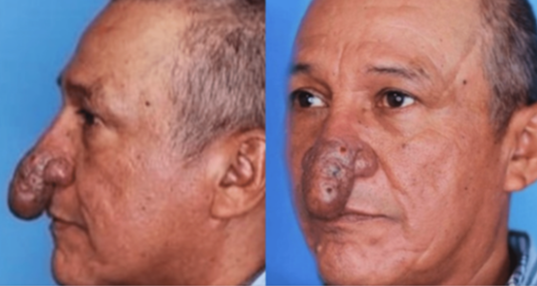 The Remarkable Transformation of Conrado’s Nose