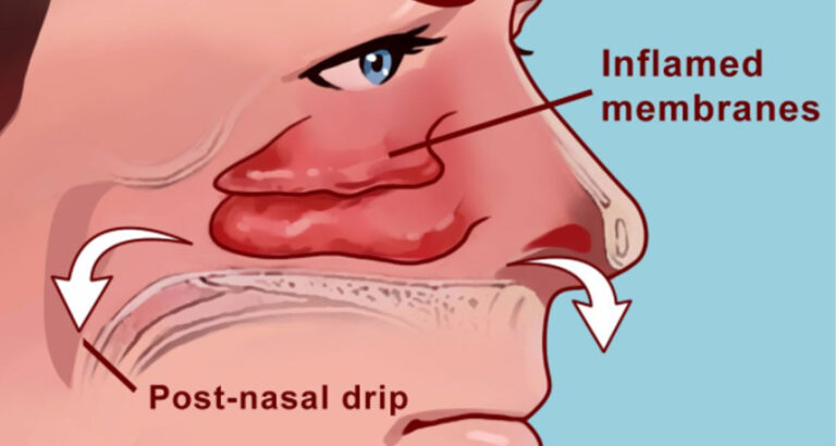 How to clear your sinuses in seconds with nothing but your fingers