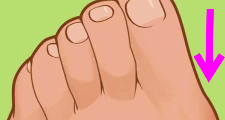 The painful bump on the side of your feet